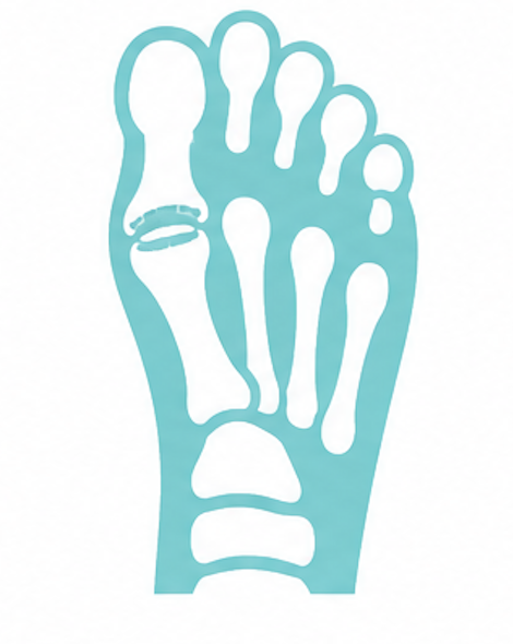 hallux valgus